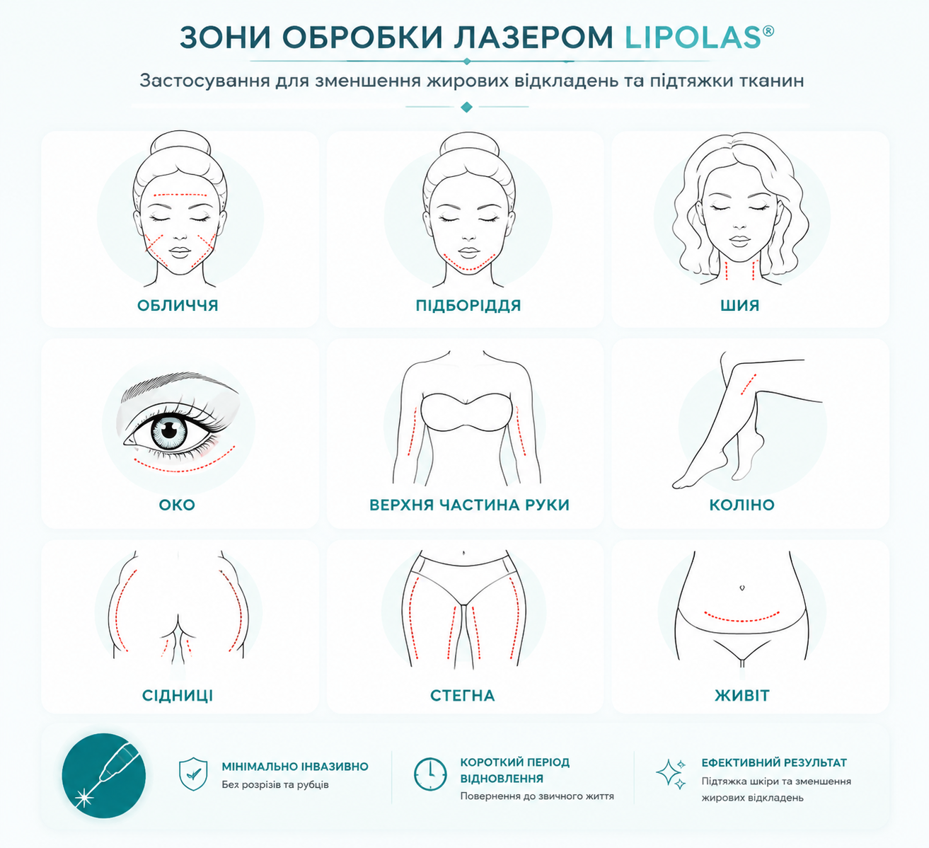Зони обробки лазером LipoLas: обличчя, підборіддя, шия, зона очей, руки, коліна, сідниці, стегна та живіт