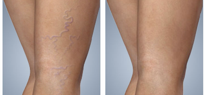 VLaze Фото до та після