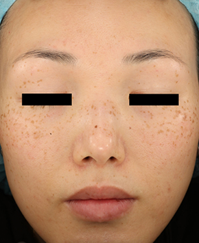 PicoWay Фото до та після