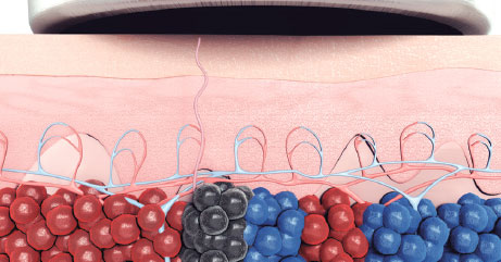 PicoWay Фото до та після