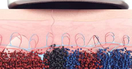 PicoWay Фото до та після