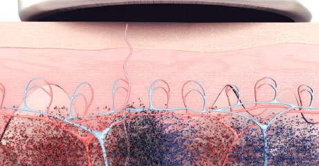 PicoWay Фото до та після