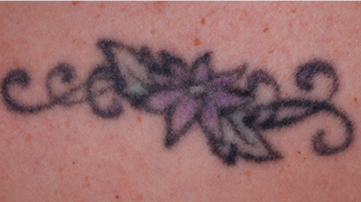 PicoWay Фото до та після