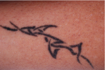 PicoWay Фото до та після