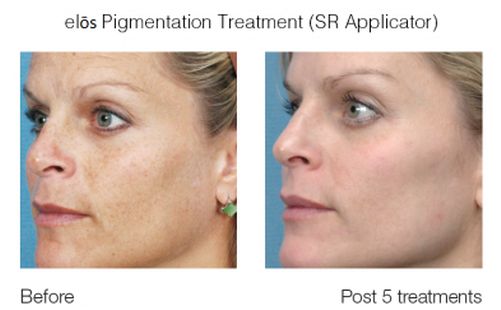 SR Фото до та після