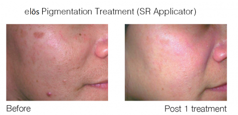 SR Фото до та після