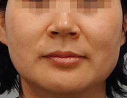 Doublo-S Фото до та після