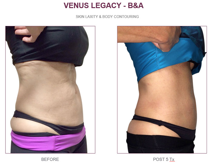 Venus Legacy Фото до та після