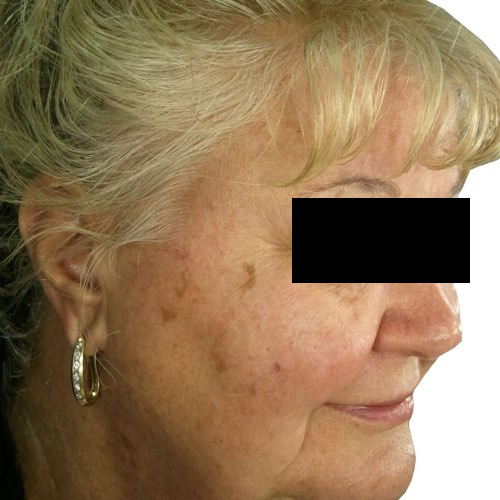 Venus Versa Фото до та після