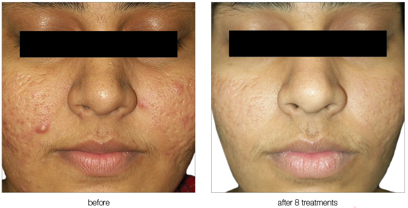 Acne dual фото