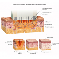 Насадка Fractora до платформи Trinon для фракційного, мікроголкового РФ омолодження, корекції зморшок та розтяжок від Inmode Invasix