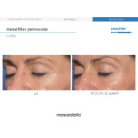 Філер для корекції зони навколо очей та зморшок Mesofiller Periocular Mesoestetic