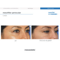 Філер для корекції зони навколо очей та зморшок Mesofiller Periocular Mesoestetic