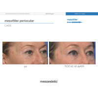 Філер для корекції зони навколо очей та зморшок Mesofiller Periocular Mesoestetic