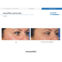 Філер для корекції зони навколо очей та зморшок Mesofiller Periocular Mesoestetic