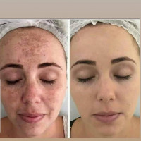 COSMELAN - PACK / ПРОФЕСІЙНА ПРОГРАМА 