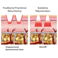 Аплікатор Matrix RF для фракційного шліфування від Candela Аплікатор Matrix RF для фракційного шліфування від Candela