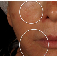 Candela eTwo - апарат для омолодження шкіри обличчя Candela eTwo - апарат для омолодження шкіри обличчя