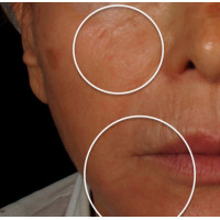 Candela eTwo - апарат для омолодження шкіри обличчя Candela eTwo - апарат для омолодження шкіри обличчя