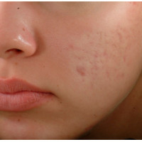 Candela eTwo - апарат для омолодження шкіри обличчя Candela eTwo - апарат для омолодження шкіри обличчя