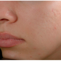 Candela eTwo - апарат для омолодження шкіри обличчя Candela eTwo - апарат для омолодження шкіри обличчя