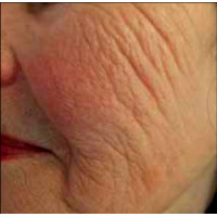 Candela eTwo - апарат для омолодження шкіри обличчя Candela eTwo - апарат для омолодження шкіри обличчя