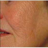 Candela eTwo - апарат для омолодження шкіри обличчя Candela eTwo - апарат для омолодження шкіри обличчя