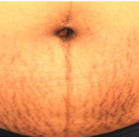 Candela eTwo - апарат для омолодження шкіри обличчя Candela eTwo - апарат для омолодження шкіри обличчя