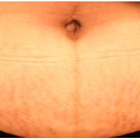 Candela eTwo - апарат для омолодження шкіри обличчя Candela eTwo - апарат для омолодження шкіри обличчя