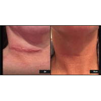 Tropocells PRP - пробірки для плазмоліфтингу