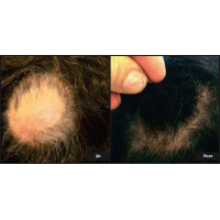 Tropocells PRP - пробірки для плазмоліфтингу