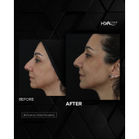 HYAcorp FACE філер для контурування обличчя