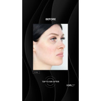 HYAcorp FACE філер для контурування обличчя