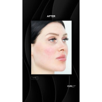 HYAcorp FACE філер для контурування обличчя