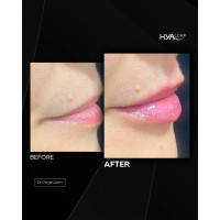 HYAcorp LIPS філер для губ