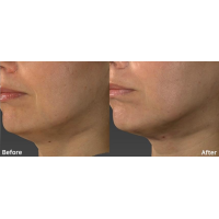 Апарат Doublo GOLD для неінвазивного SMAS ліфтингу від Hironic