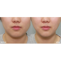 Апарат Doublo GOLD для неінвазивного SMAS ліфтингу від Hironic