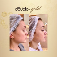 Апарат Doublo GOLD для неінвазивного SMAS ліфтингу від Hironic