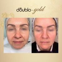 Апарат Doublo GOLD для неінвазивного SMAS ліфтингу від Hironic