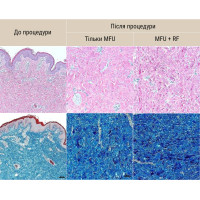 Апарат New Doublo HIFU + RF ліфтинг Апарат New Doublo HIFU + RF ліфтинг