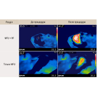 Апарат New Doublo HIFU + RF ліфтинг Апарат New Doublo HIFU + RF ліфтинг