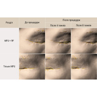 Апарат New Doublo HIFU + RF ліфтинг Апарат New Doublo HIFU + RF ліфтинг