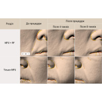 Апарат New Doublo HIFU + RF ліфтинг Апарат New Doublo HIFU + RF ліфтинг