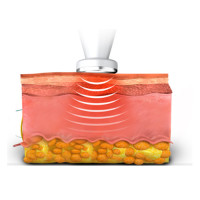 Радіочастотний монополярний круг RC | RF – Circle для Hironic GENTLO Радіочастотний монополярний круг RC | RF – Circle для Hironic GENTLO