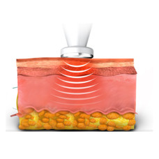 Радіочастотний монополярний круг RC | RF – Circle для Hironic GENTLO