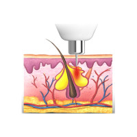 Радіочастотна монополярна голка RN | RF для Hironic GENTLO Радіочастотна монополярна голка RN | RF для Hironic GENTLO