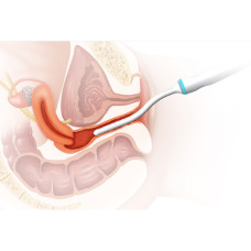 RV | RF – Vaginal для Hironic GENTLO, спеціальна вагінальна процедура з зручним радіохвильовим лікуванням