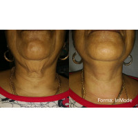 Насадка Forma до платформи Trinon для RF омолодження обличчя та шиї від Inmode Invasix