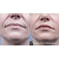 Насадка Forma до платформи Trinon для RF омолодження обличчя та шиї від Inmode Invasix