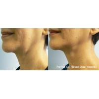 Насадка Forma до платформи Trinon для RF омолодження обличчя та шиї від Inmode Invasix